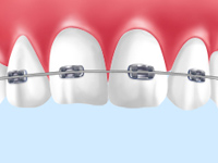ブラケット矯正