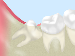 親知らずの抜歯